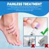 Hot Nail Fungal Pen Anti Fungus Blue Light Laser Pen Onychomycosis Painless Nail Repair Pen Nail Care Repair Serum - 1